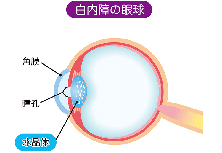 白内障の眼球のイラスト
