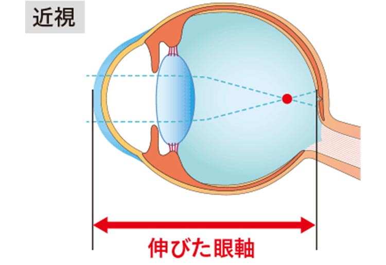 目の構造：近視のイラスト