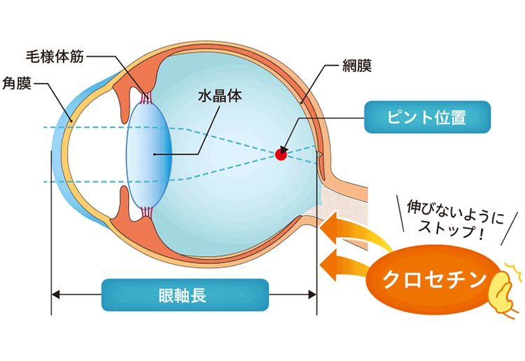 目の構造：近視のイラスト